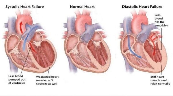 Heart failure arises as a result of the heart not being able to pump blood properly which cause breathing problems.