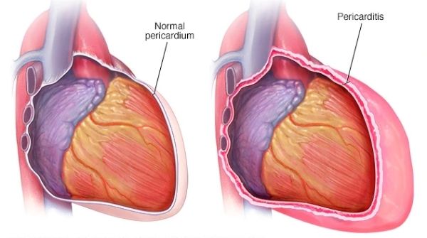 Pericarditis is the inflammation of the pericardium, a thin sack membrane surrounding the heart cause breathing problems.