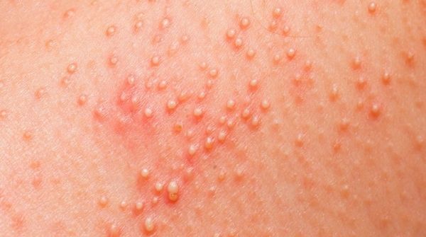 The meaning of this type of skin rash is, overheat and clogged pores will produce rashes on the body.