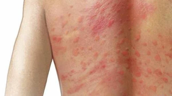 The meaning of this skin rash is that hives are caused due to allergic reactions in the body.