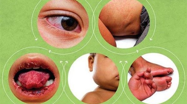 Kawasaki disease affects the gland, swelling in the lymphoid nodes, skin & mucous membrane in the nose, throat & mouth.