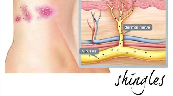 Shingles is a painful and it is caused by the chickenpox virus and spreads on the body.