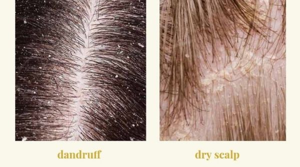 Dandruff and dry scalp should be cleared very immediately because it will cause severe hair loss.