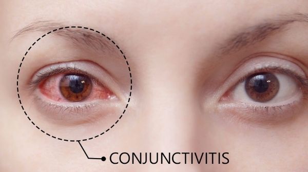Conjunctivitis is inflammation of the conjunctiva & the symptoms of eye are reddish or pink color appearance.