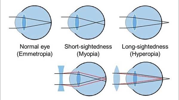 Types of refractive error are hyperopia, myopia, astigmatism, presbyopia. They will not able to focus light properly.