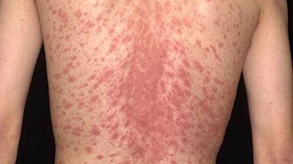The meaning of the skin rash is, it may resemble like Christmas tree or pine tree branches pattern in back of the body.