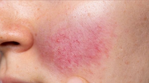 The meaning of skin rash, contact dermatitis, occur when the skin gets direct contact with the allergens.