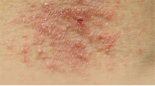 Eczema is also called atopic dermatitis. Sign & symptoms are dry white scaly patches that flake off from the skin.