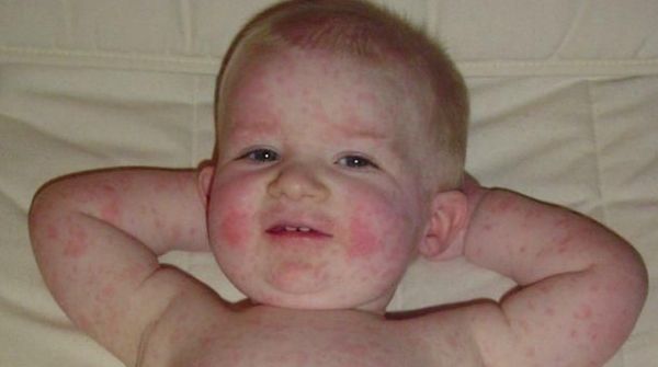 Fifth disease is a viral disease that results in reds on cheeks, arms, legs & also called slapped cheek disease.