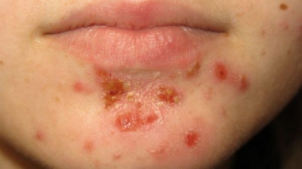 Impetigo is a bacterial disease where it causes skin allergy to affect the face, hands, neck with crusty sores.