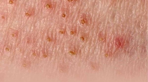 Lichen planus is an inflammatory condition that develops on the skin & mucous membranes & it can occur at any age.
