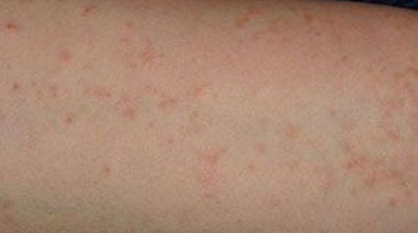 Sarcoptes scabies, a burrowing mite causes itchy skin allergy. Scabies is contagious & will spread by physical contact.
